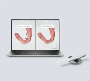 3D Intraoral Scanner